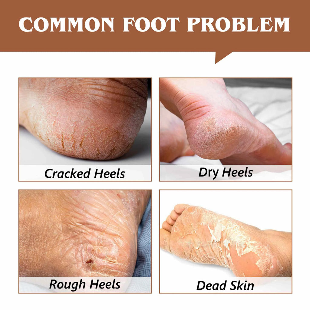Aliver Cracked Heel Repair Balm, Balm for Rough Heels, for Dry Skin & Cracked Feet Hydration,(Coconut)2.46Oz