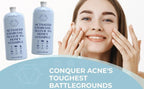 Acne Face Wash with Charcoal & Sulfur, Cystic & Hormonal Acne Cleanser, 8 Fl Oz,