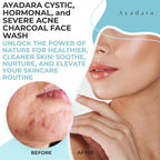 Acne Face Wash with Charcoal & Sulfur, Cystic & Hormonal Acne Cleanser, 8 Fl Oz,