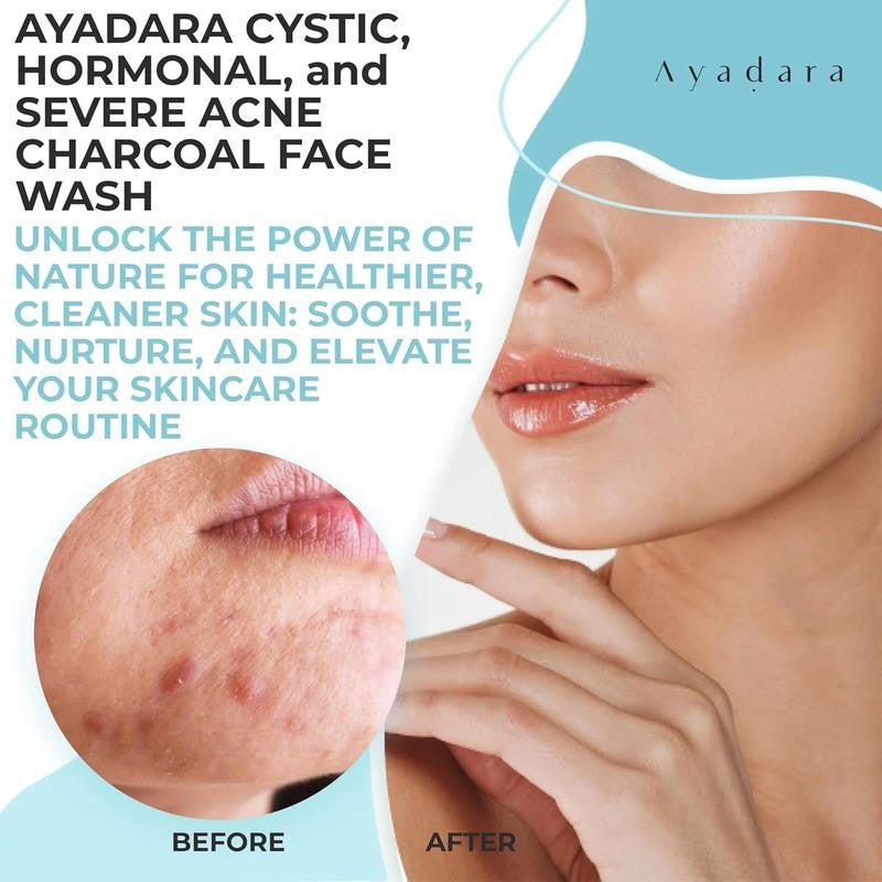 Acne Face Wash with Charcoal & Sulfur, Cystic & Hormonal Acne Cleanser, 8 Fl Oz,