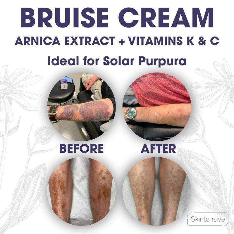 Arnica & Vitamin K Bruise Cream - Extra Strength Fast Repair for Thin Skin, Rene