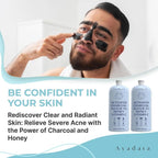 Acne Face Wash with Charcoal & Sulfur, Cystic & Hormonal Acne Cleanser, 8 Fl Oz,